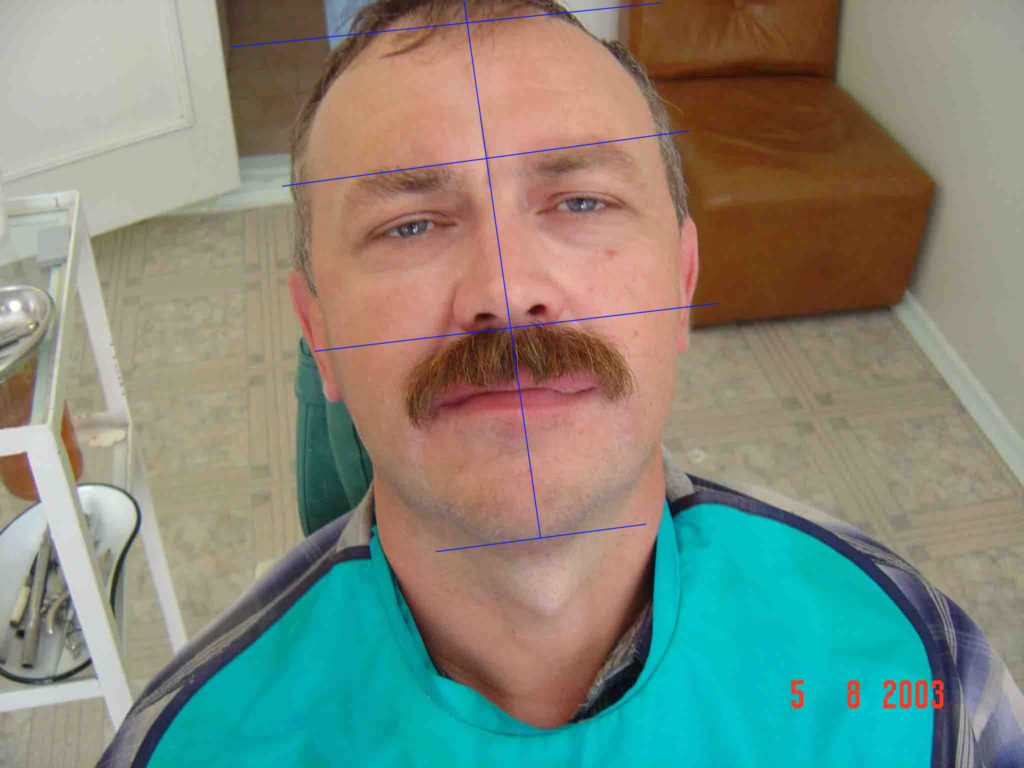 снижение высоты нижнего отдела лица